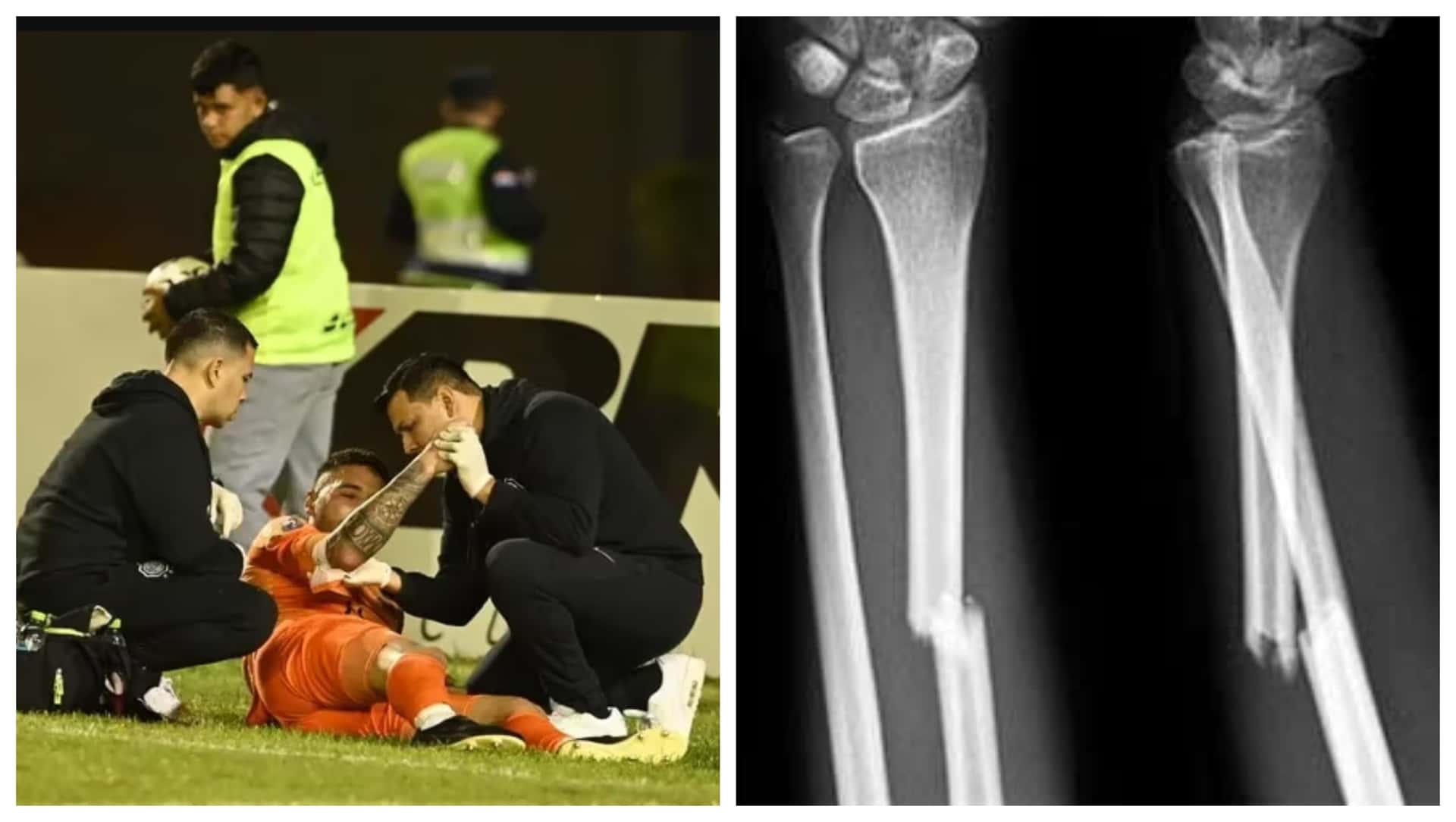 El arquero uruguayo viene recuperándose de su fractura en el antebrazo.